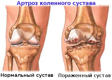 Артроз коленного сустава и нормальный сустав