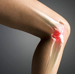 Симптомы и степени гонарттроза коленного сустава