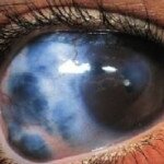 Что такое глаукома? Симптомы