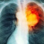 Основные симптомы рака лёгких