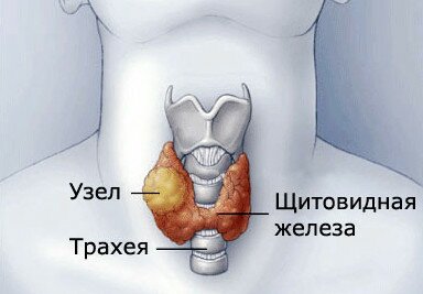 Узловой тиреоид - болезнь щитовидки