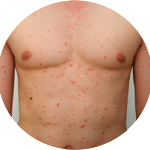 Симптомы и лечение псориаза кожи